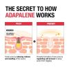 imageNeutrogena 01 Adapalene Gel Acne Treatment Topical for Acne Adapalene Medication for Blemishes Once Daily Topical Retinoid to Prevent Breakouts Oil ampamp FragranceFree 16 oz