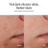 imageNeutrogena OilFree Acne Face Wash Fragrance Free Sensitive Skin Facial Cleanser with 2 Salicylic Acid Acne Treatment for Face 91 Fl Oz