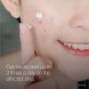 imageNeutrogena Rapid Clear Stubborn Acne Spot Treatment Gel with Maximum Strength 10 Benzoyl Peroxide Acne Treatment Medication Pimple Cream for Acne Prone Skin Care 1 oz 2 Pack