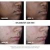 imageNeutrogena Stubborn Acne AM Face Treatment with 25 Micronized Benzoyl Peroxide Acne Medication OilFree Daily Facial Treatment Reduces Size ampamp Redness of Breakouts ParabenFree 20 oz